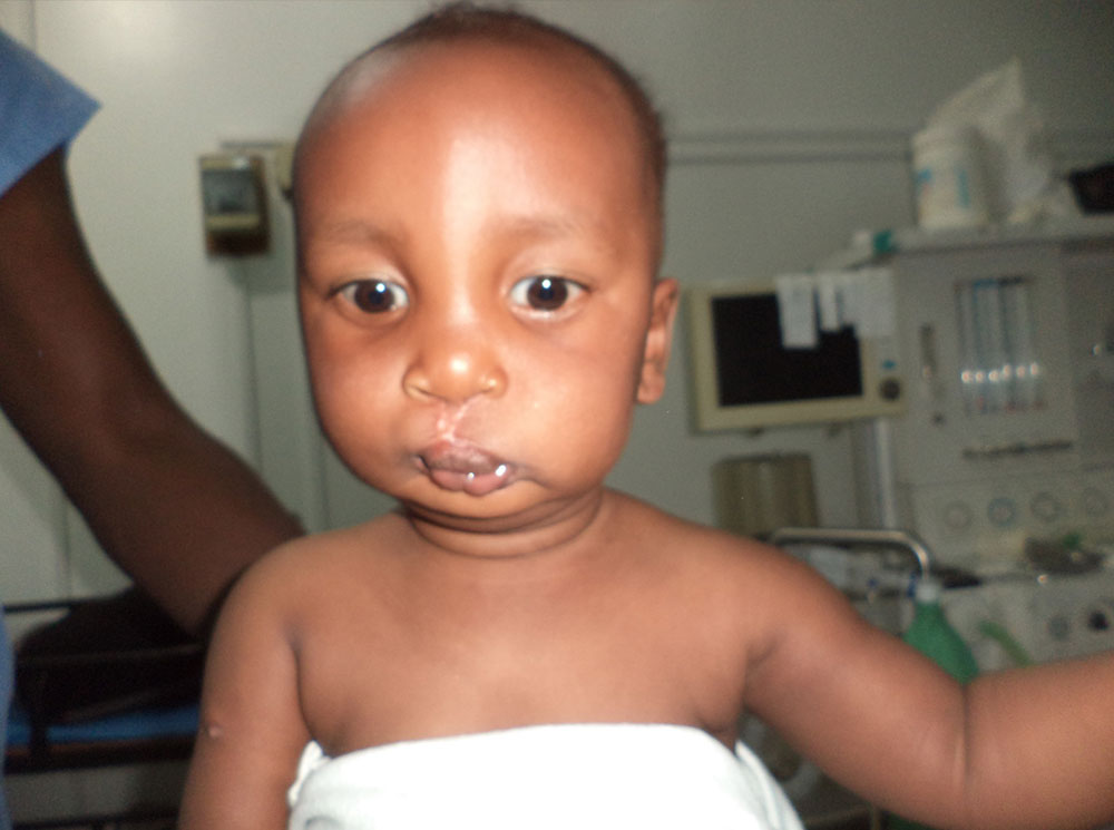 Eric after cleft surgery