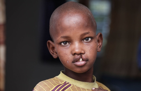 young man with untreated cleft