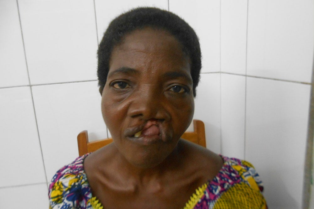 Adjoa before cleft surgery