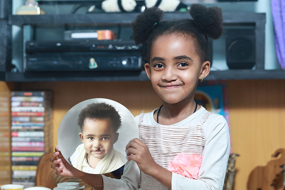 Marsillas smiling and holding a photo of herself before cleft surgery