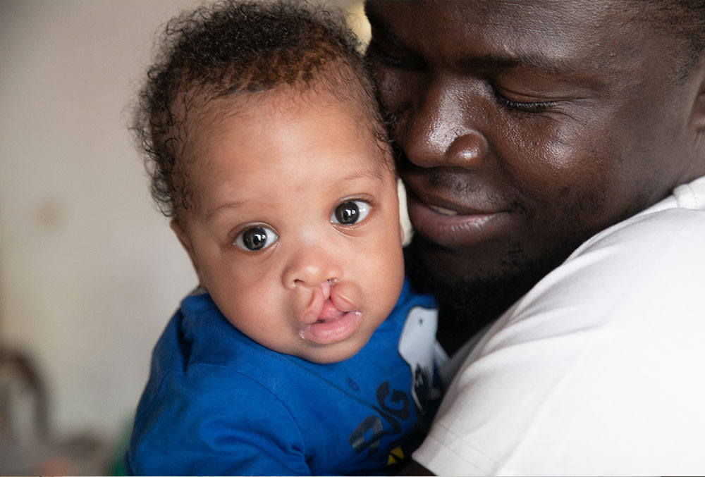 Hervé smiling and hugging Lloyd before his cleft surgery