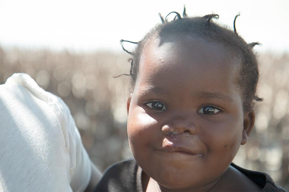 Zena smiling after cleft surgery