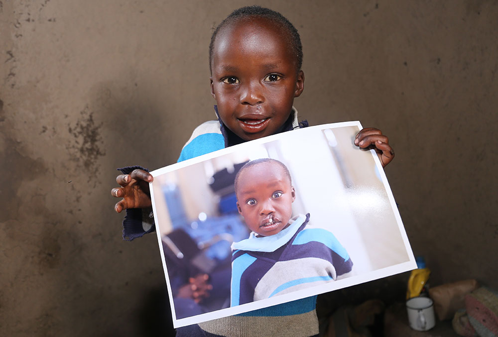 Benjamin smiling and holding a photo of himself before cleft surgery