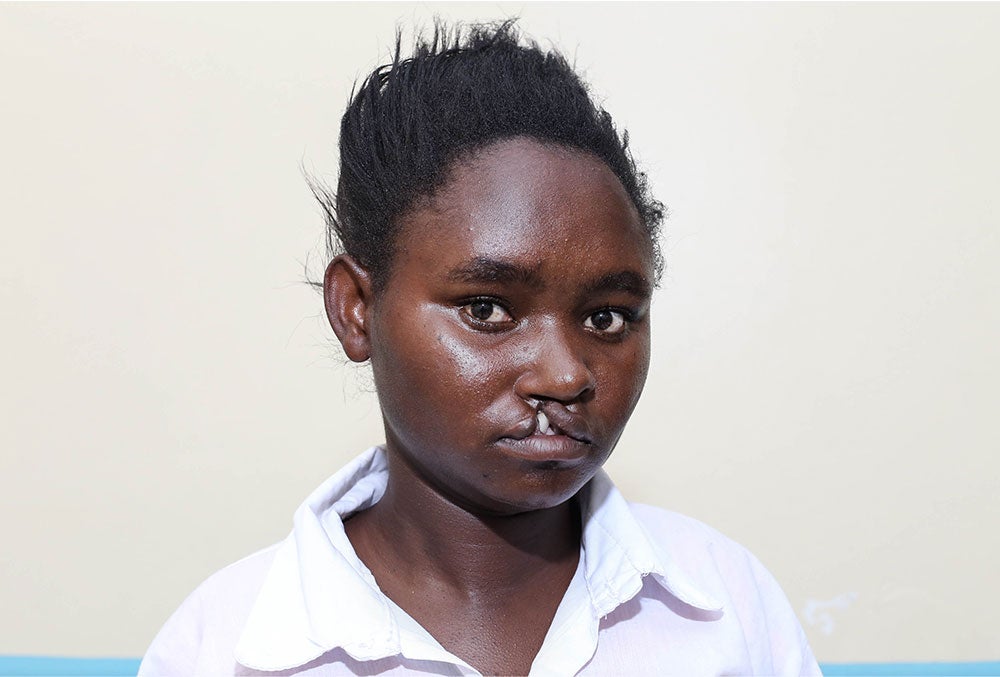 Damaris before cleft surgery