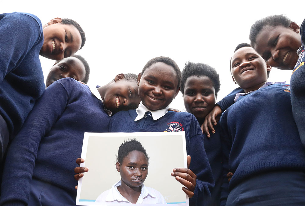 Damaris smiling with her friends and holding a photo of herself before cleft surgery