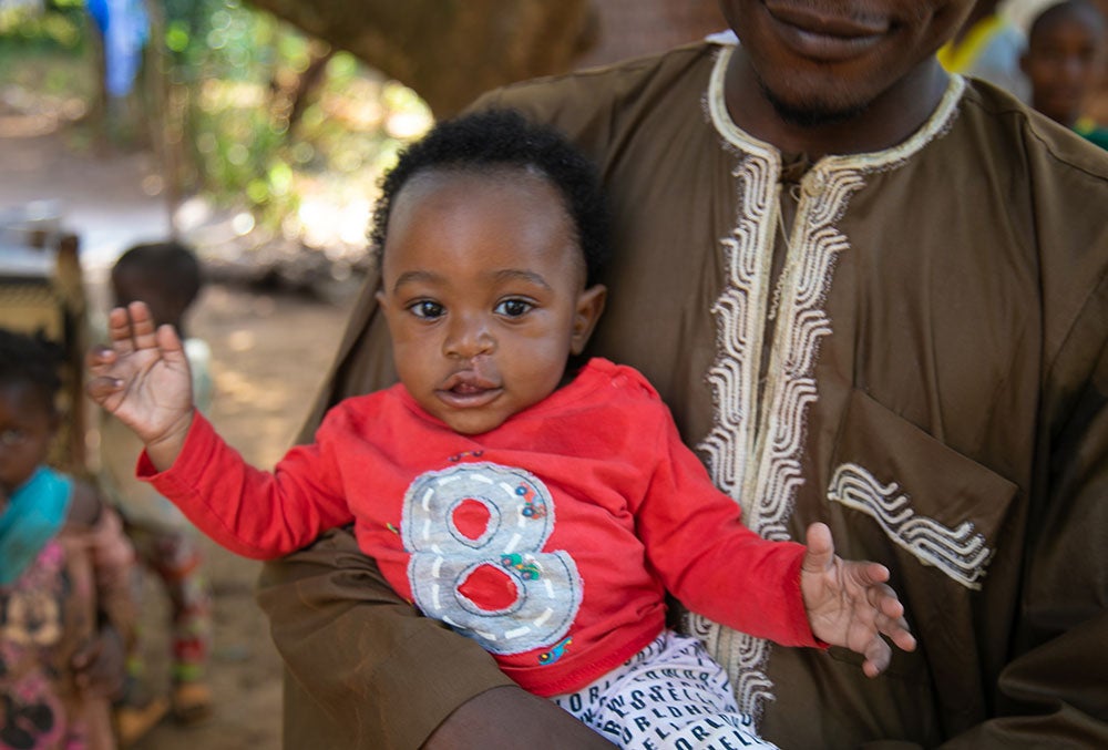 Mouhamed after cleft surgery