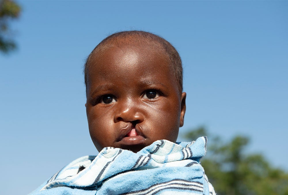 Nyasha before cleft surgery