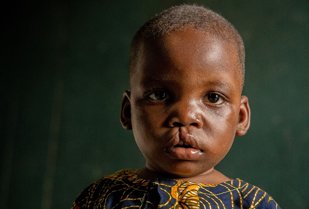 Opeyemi before cleft surgery