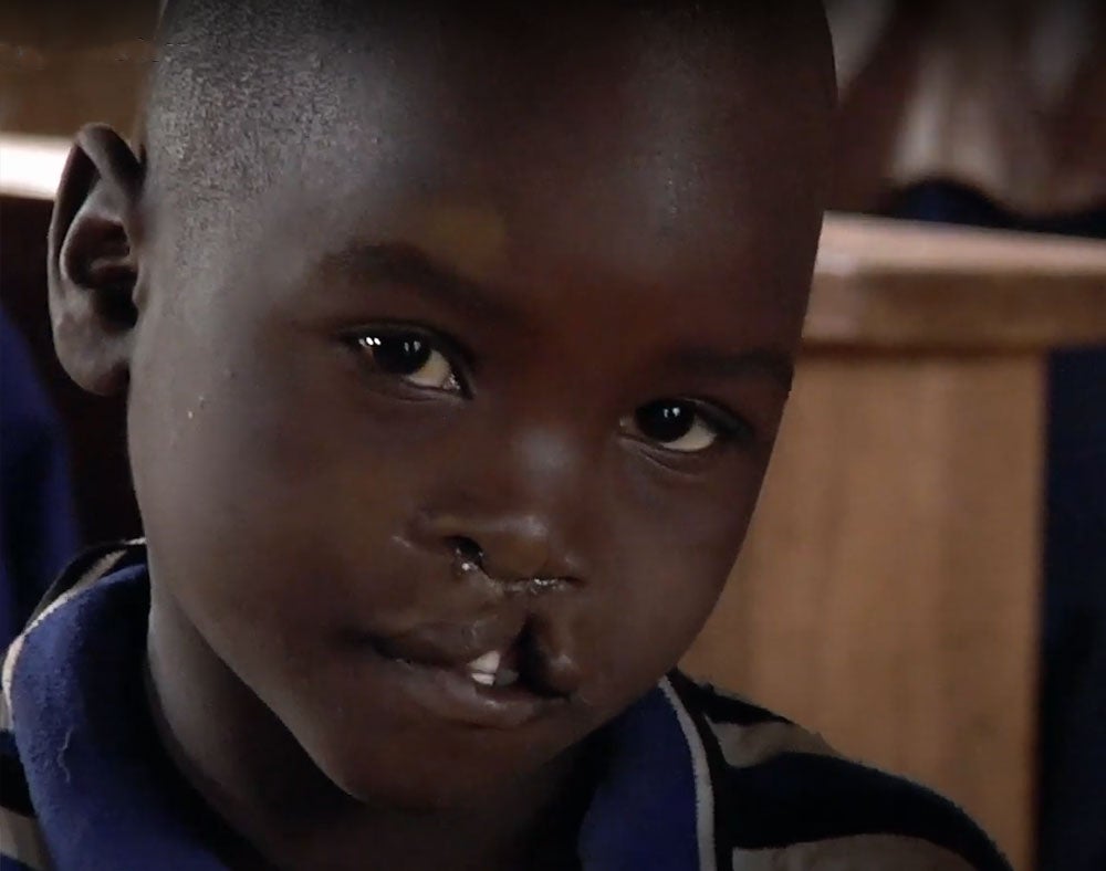 Osawa before cleft surgery