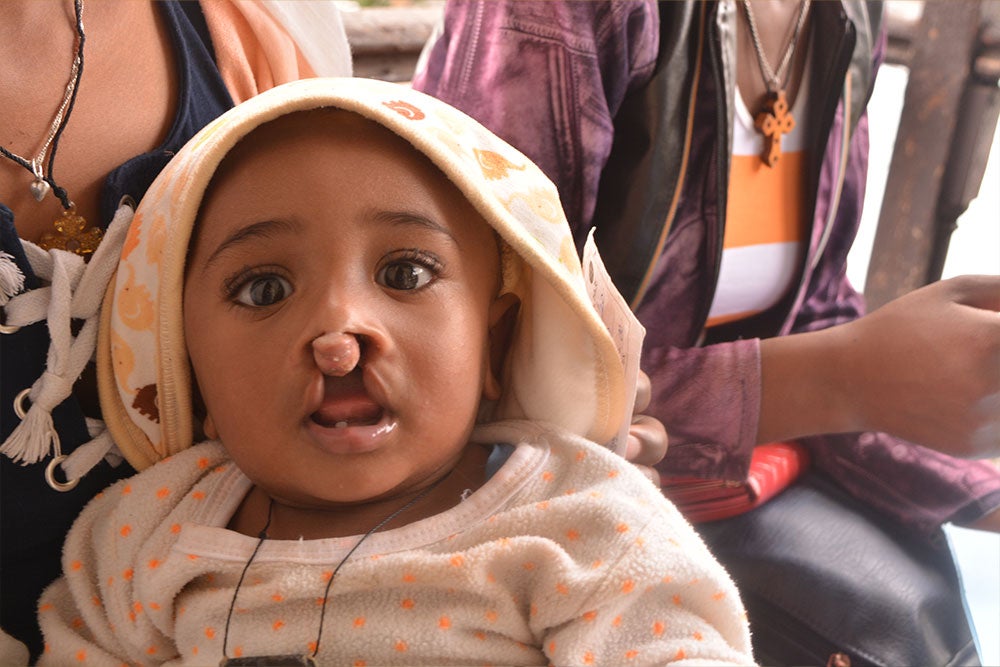 Yohanes before cleft surgery