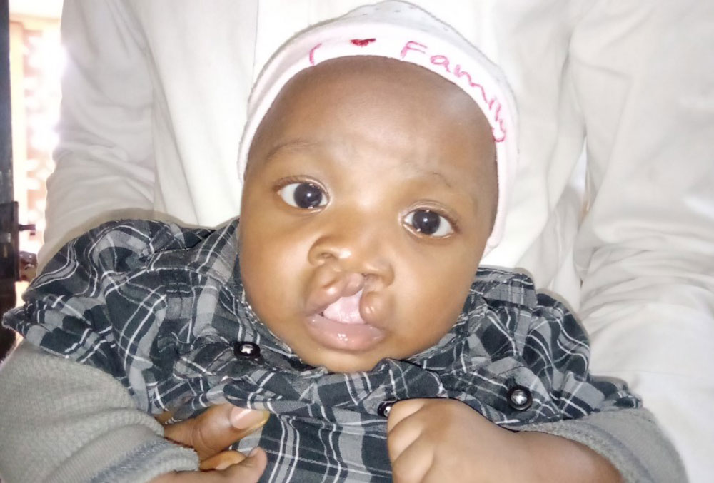 Annointed before cleft surgery