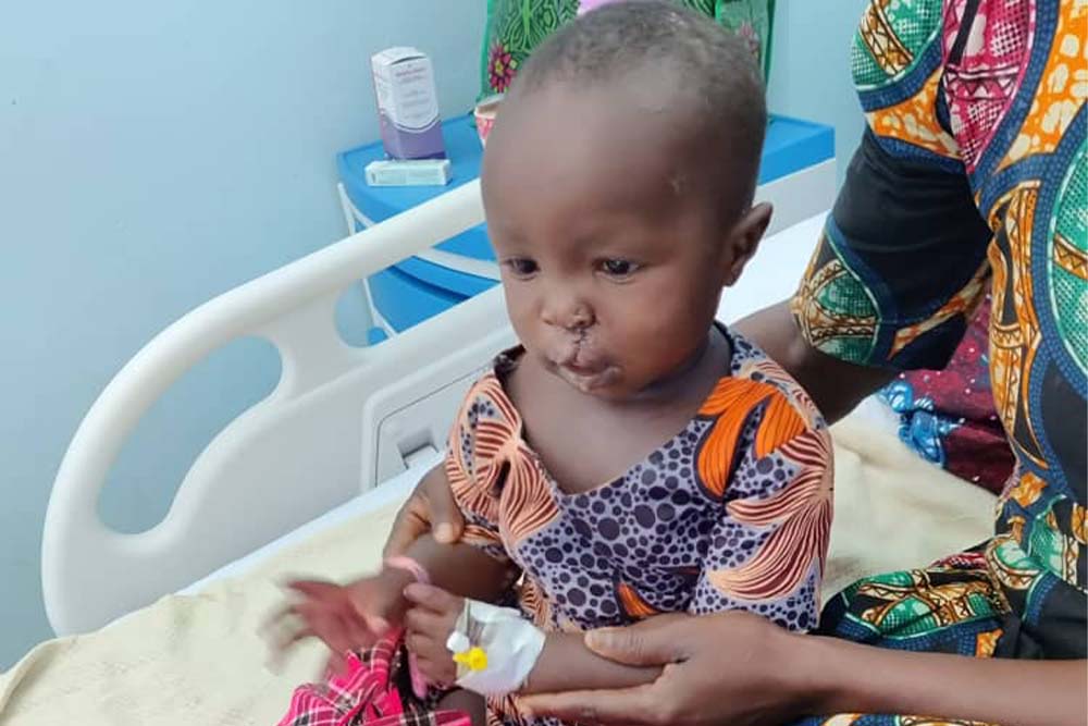 Cleft-affected patient after surgery