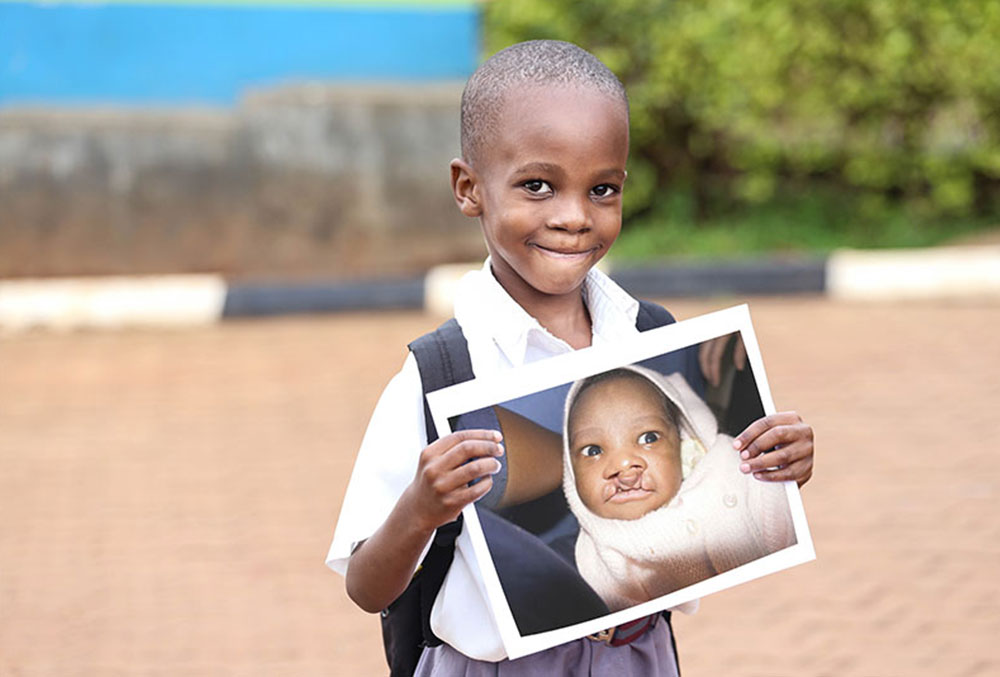 Livingstone smiling and holding a photo of himself before cleft surgery