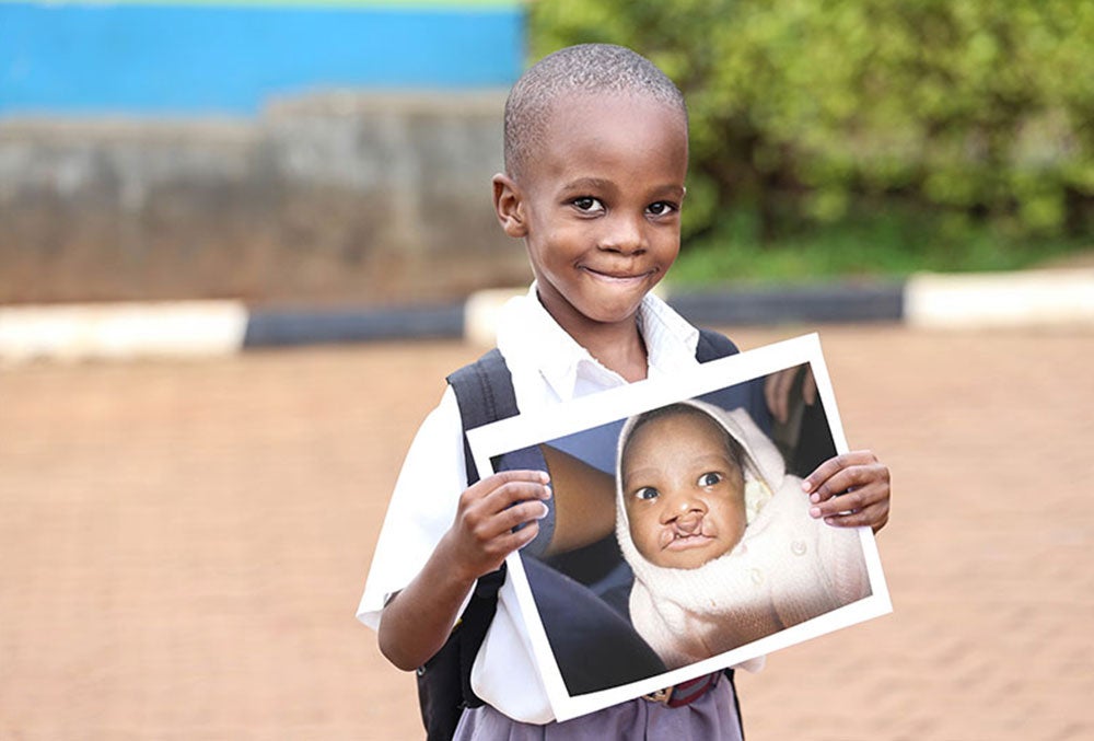 Livingstone smiling and holding a photo of himself before cleft surgery