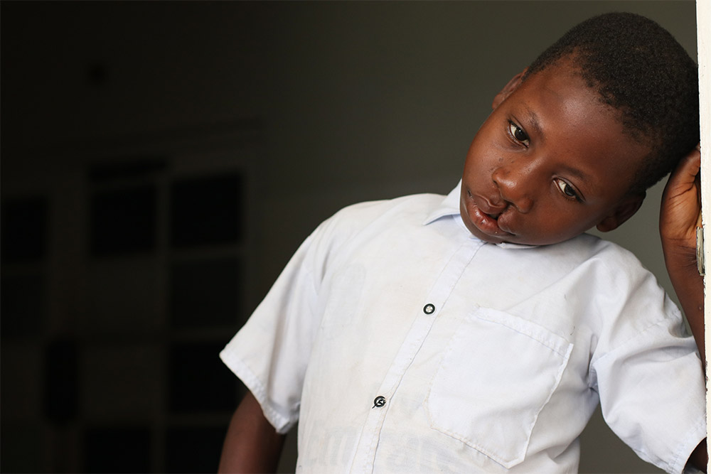 Nkunda leaning against a door before cleft surgery