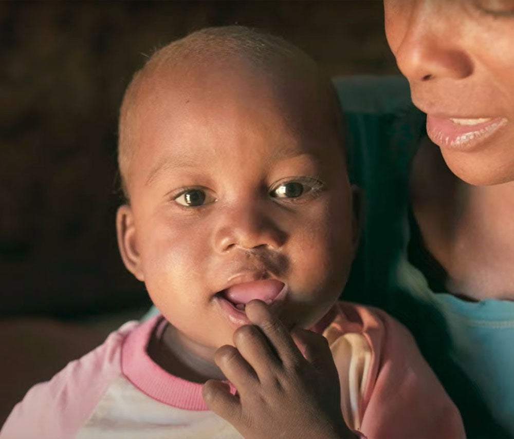 Simon smiling after cleft surgery