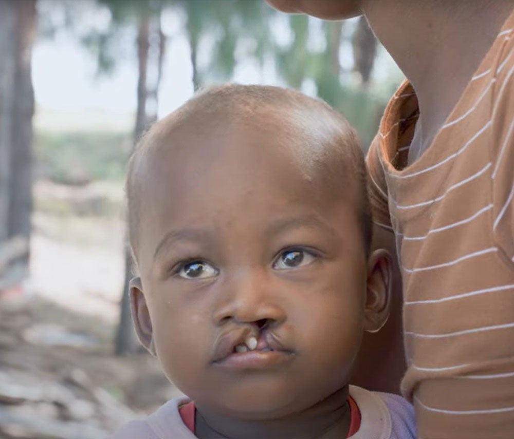 Simon before cleft surgery