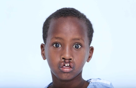 Shariif before cleft surgery