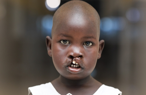 Girl with a cleft lip