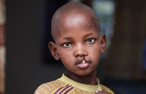 young man with untreated cleft