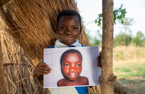 Akuya smiling and holding a picture of herself before cleft surgery