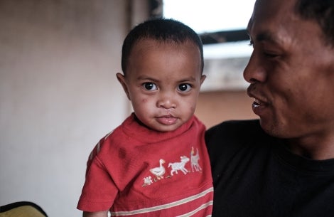 Eden smiling after cleft surgery
