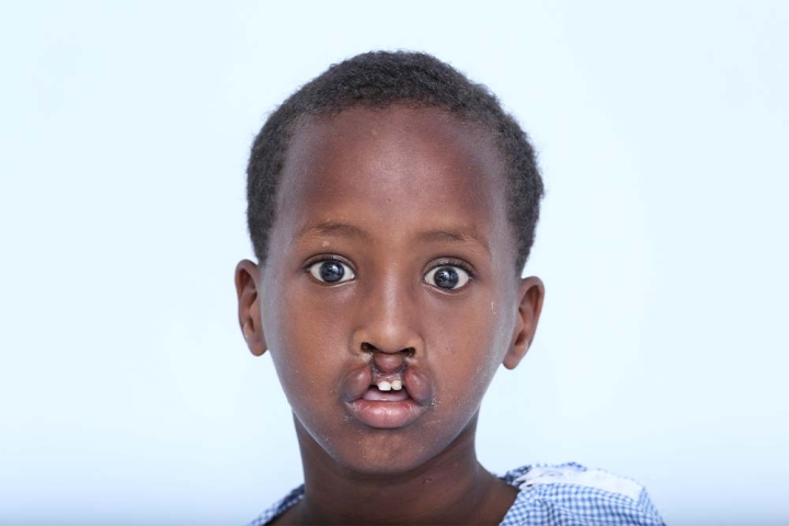 Shariif before cleft surgery