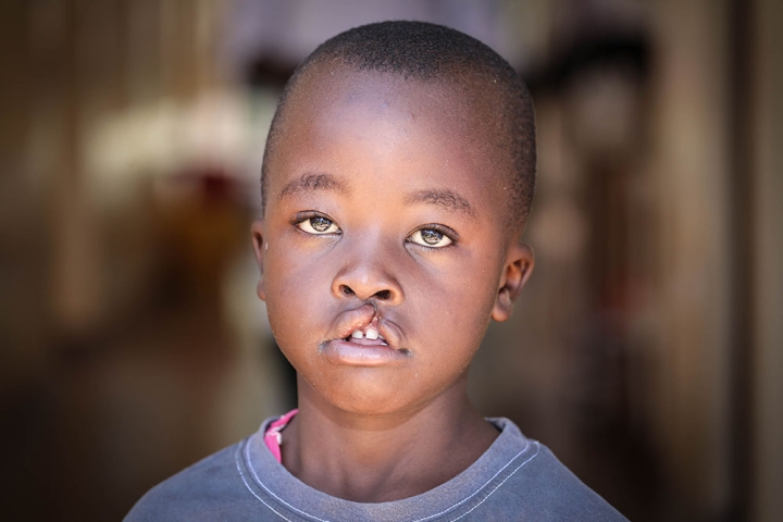 Boy from Kenya with a cleft lip