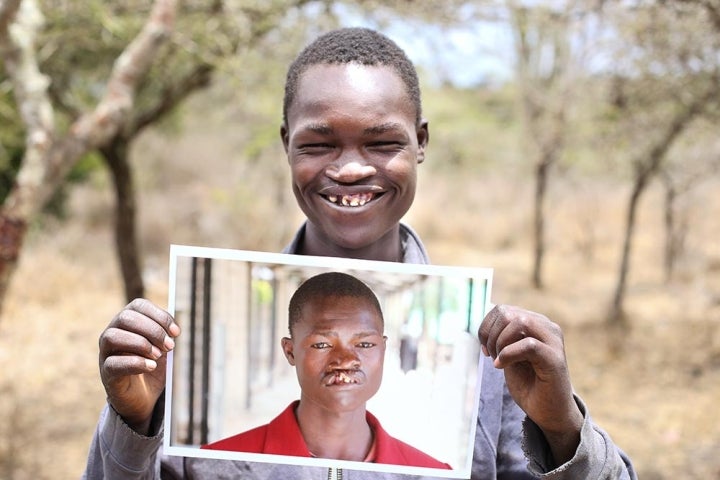 Teen boy after cleft surgery