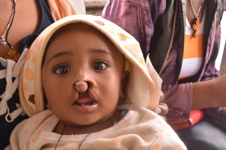 infant with a bilateral cleft