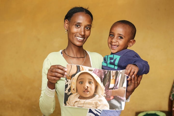 Yohanes smiling with his mother Atsede and holding a photo of himself before cleft surgery