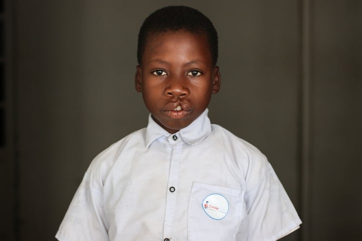 Nkunda before cleft surgery