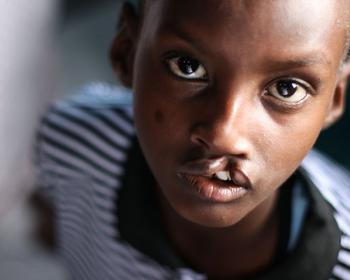 boy with an untreated cleft lip