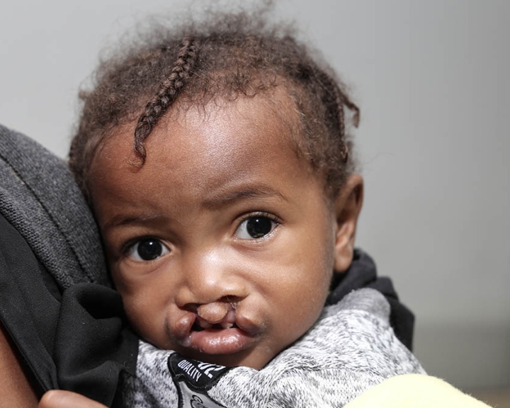 infant with a bilateral cleft