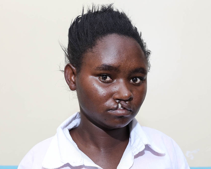 teenager with a cleft lip