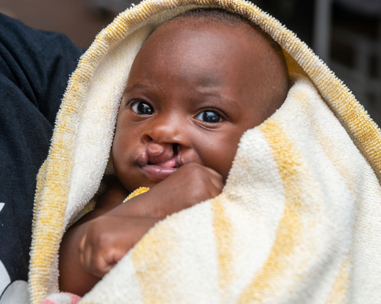 Cleft-affected baby before cleft surgery