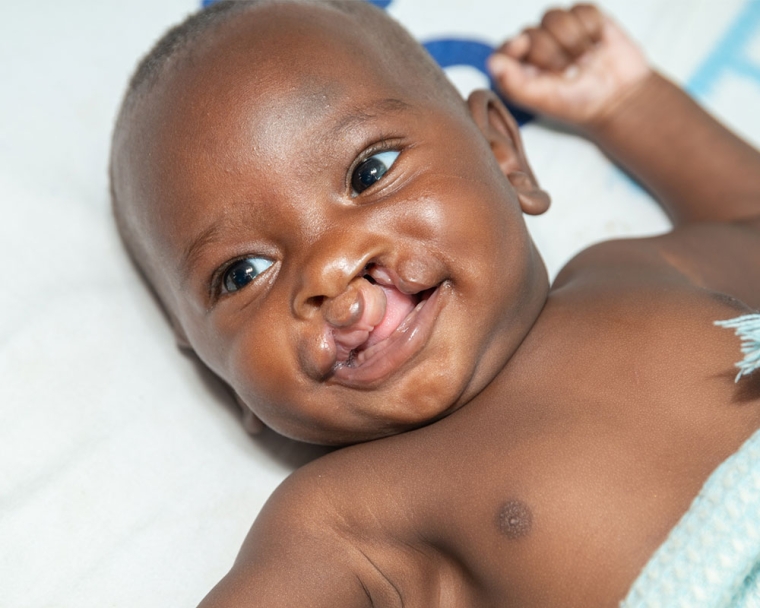 Cleft-affected baby smiling before cleft surgery