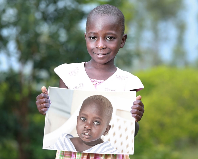 Girl hold image of herself before cleft lip surgery