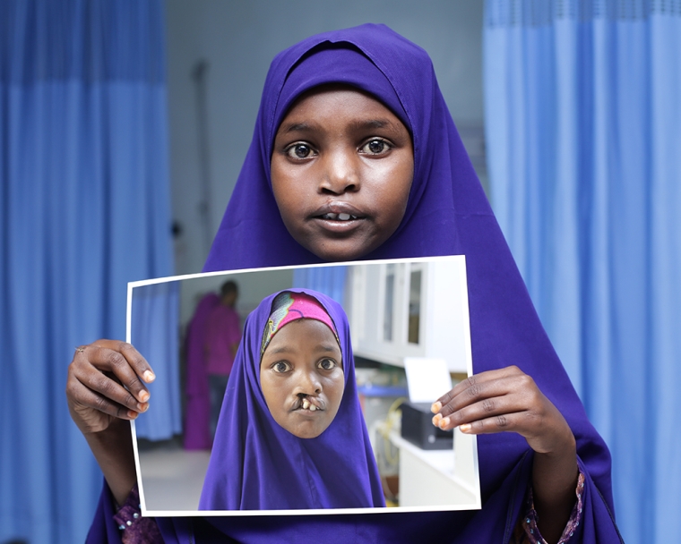 Girl holds up image of herself before cleft lip surgery