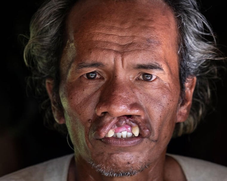 Alim avant la chirurgie de la fente