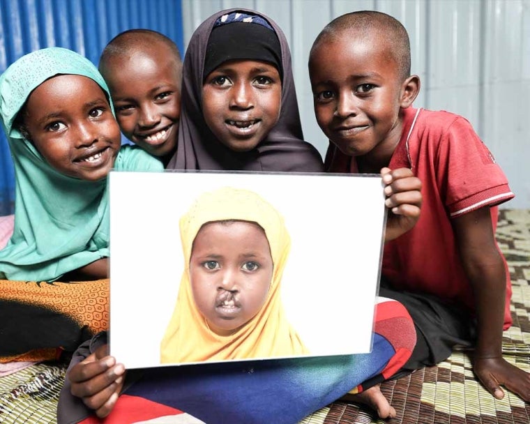 Nasro smiling and holding picture of herself before cleft surgery